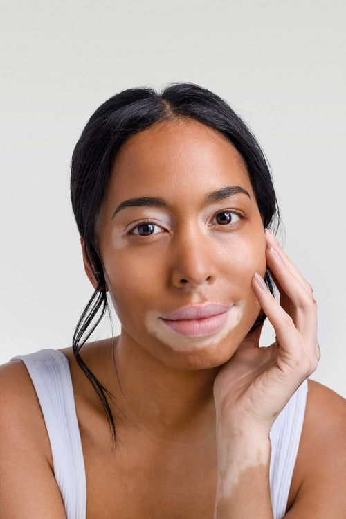 Vitiligo : qu’est-ce que c’est et comment le traiter ?
