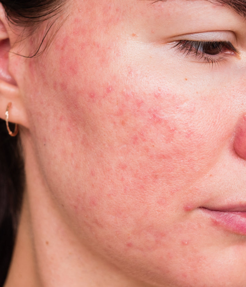 Rosacée : pourquoi l'acide azélaïque est devenu un actif de référence contre les rougeurs et les poussées inflammatoires
