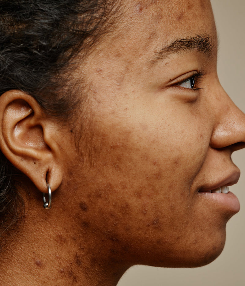 Taches d'acné et hyperpigmentation post-inflammatoire : pourquoi les peaux mates et foncées sont plus exposées ?