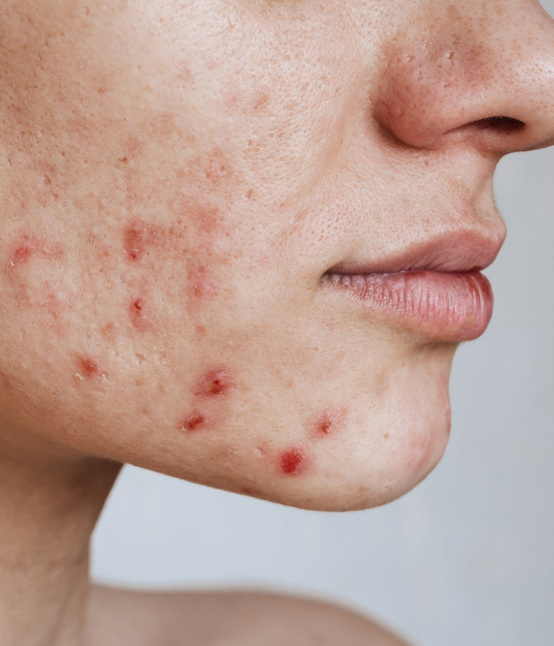 Acné hormonal : comment la reconnaître et la soigner ?