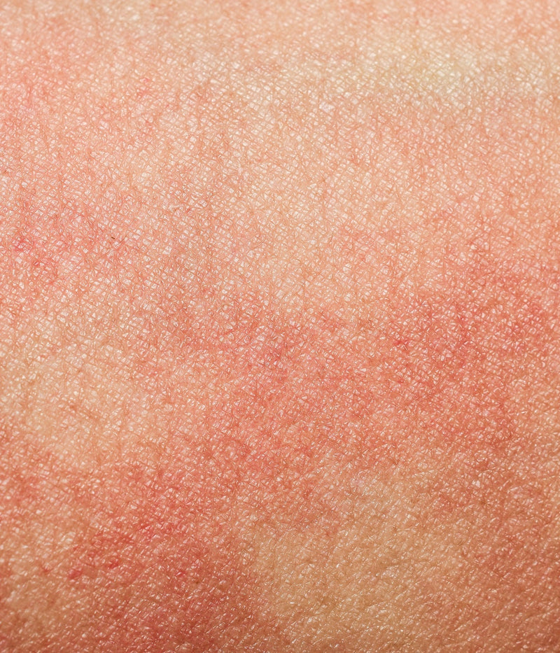 Comment reconnaître une dermatite atopique ?