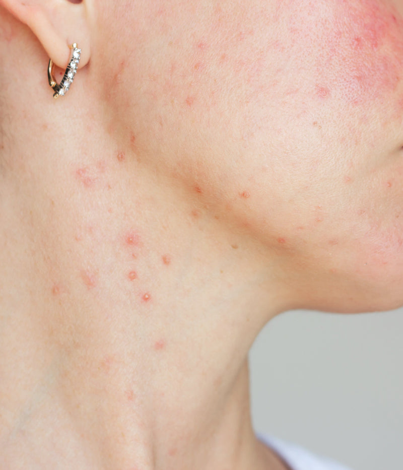 Rougeur du visage : que faire ?
