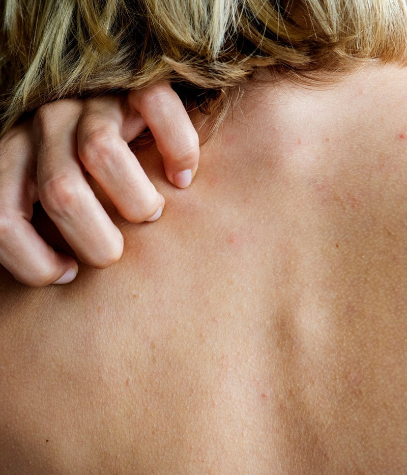 Qu’est-ce qui déclenche une dermatite atopique ?