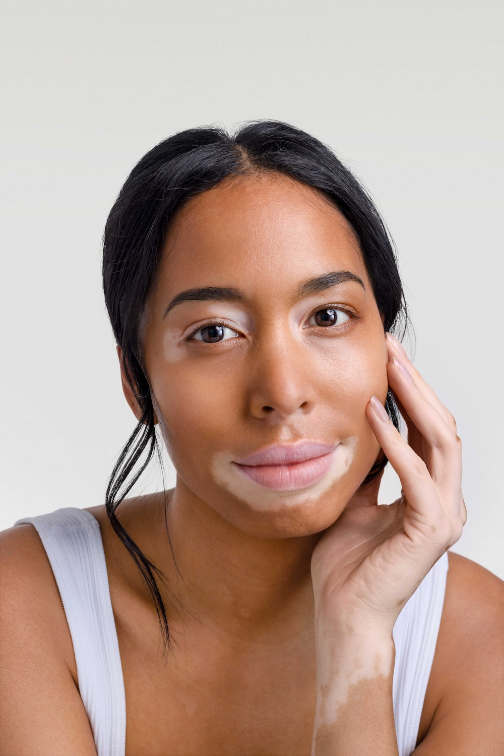 Vitiligo: what is it and how to treat it? Vitiligo: what is it and how to treat it?