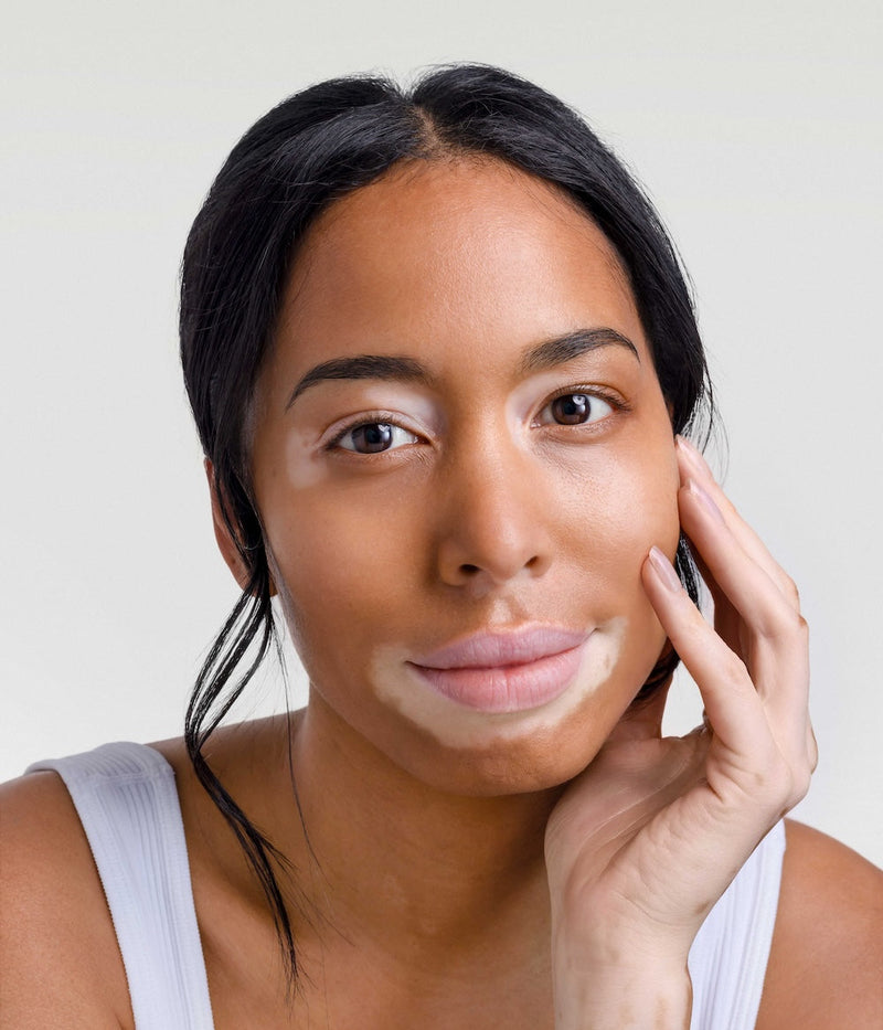 Vitiligo : qu’est-ce que c’est et comment le traiter ?
