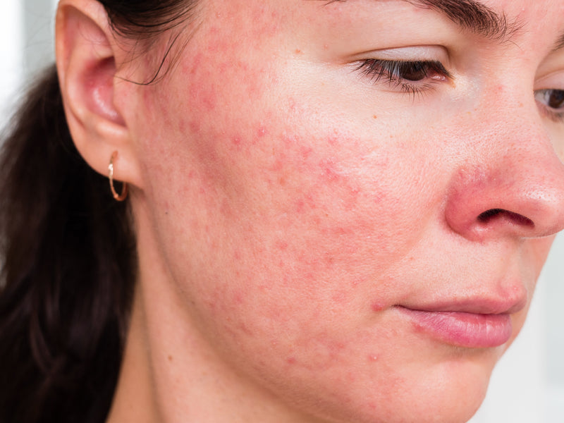 Rosacée : pourquoi l'acide azélaïque est devenu un actif de référence contre les rougeurs et les poussées inflammatoires