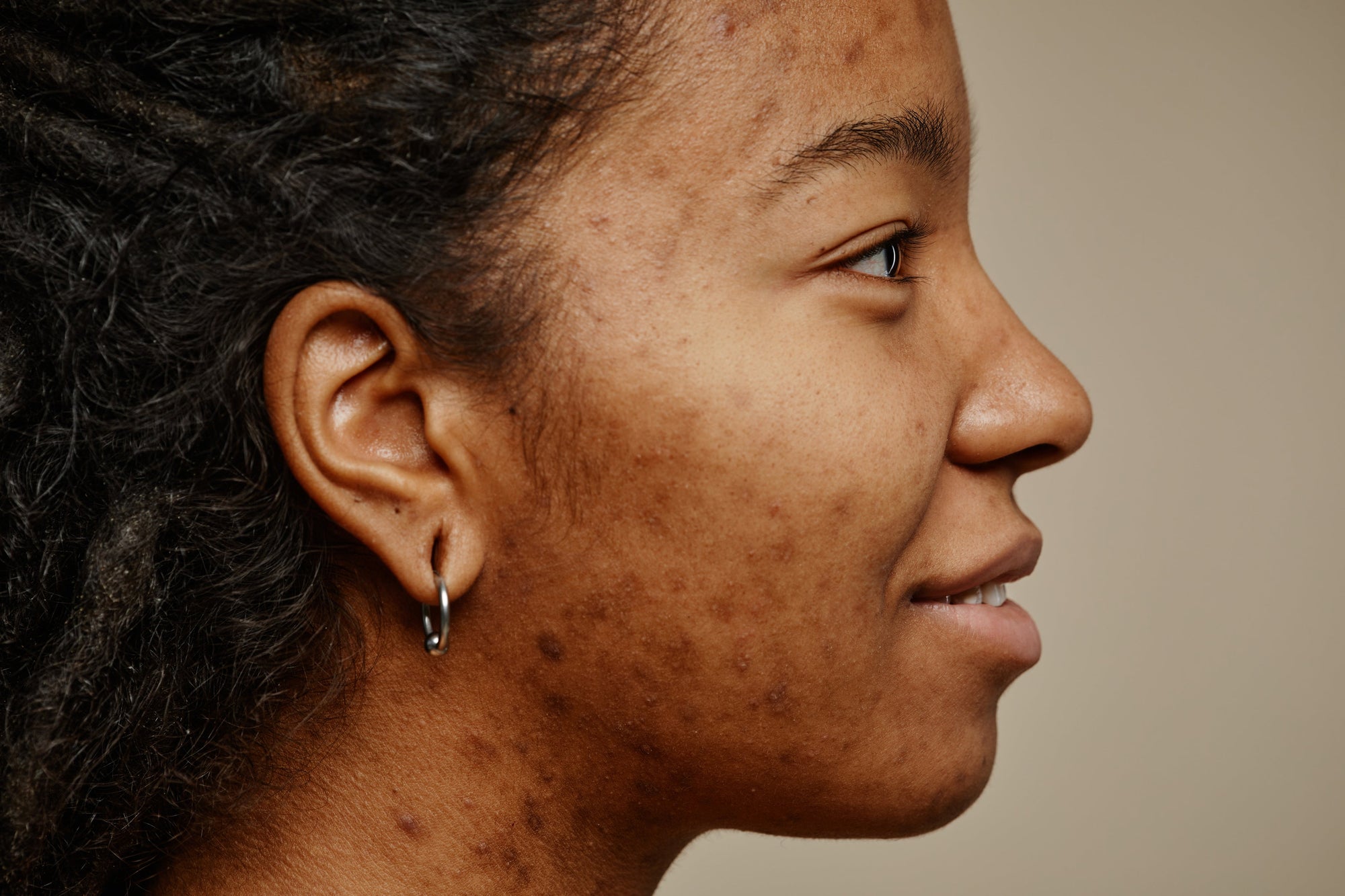 Taches d'acné et hyperpigmentation post-inflammatoire : pourquoi les peaux mates et foncées sont plus exposées ?