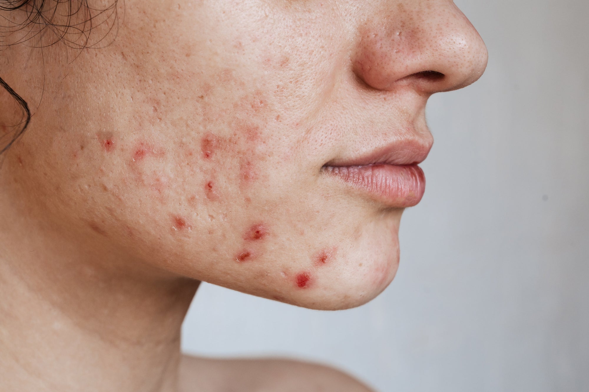 Acné hormonal : comment la reconnaître et la soigner ?