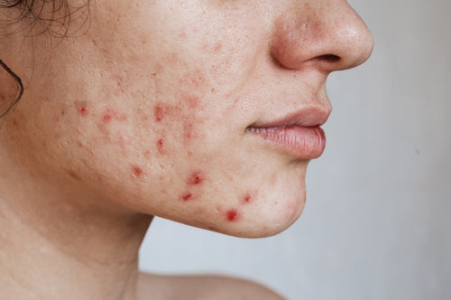 Acné hormonal : comment la reconnaître et la soigner ?