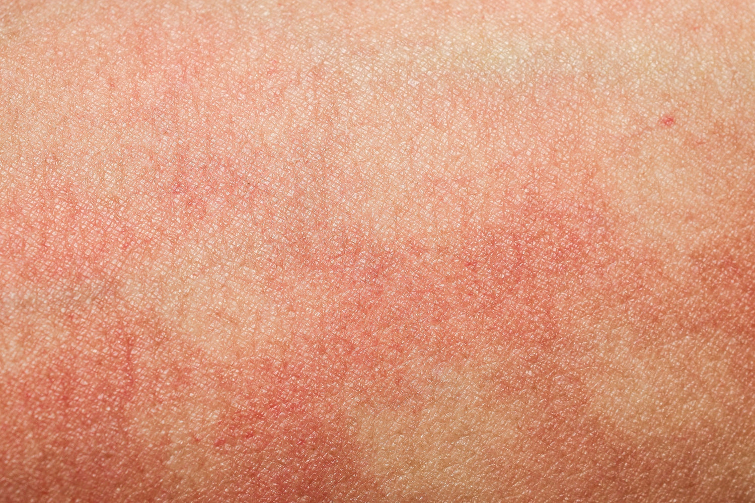 Comment reconnaître une dermatite atopique ?
