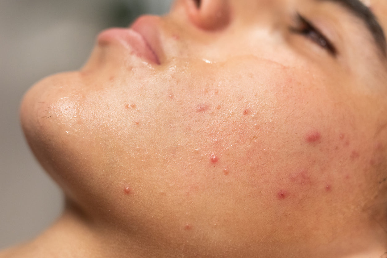 Taches post-acné : comprendre l'hyperpigmentation post-inflammatoire