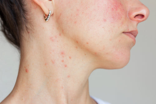 Rougeur du visage : que faire ?