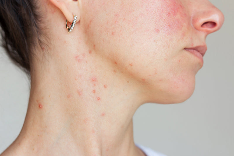 Rougeur du visage : que faire ?