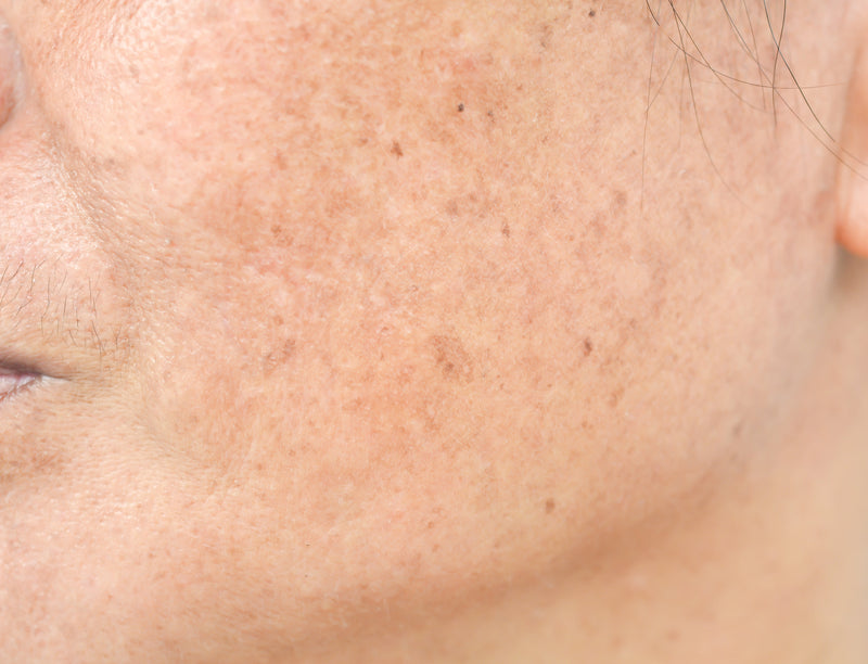 Comment reconnaître les taches pigmentaires ? Types, causes et traitements