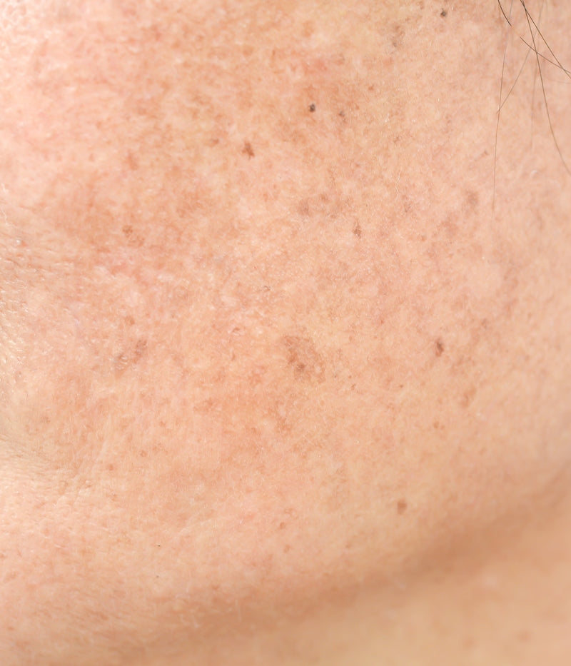 Comment reconnaître les taches pigmentaires ? Types, causes et traitements