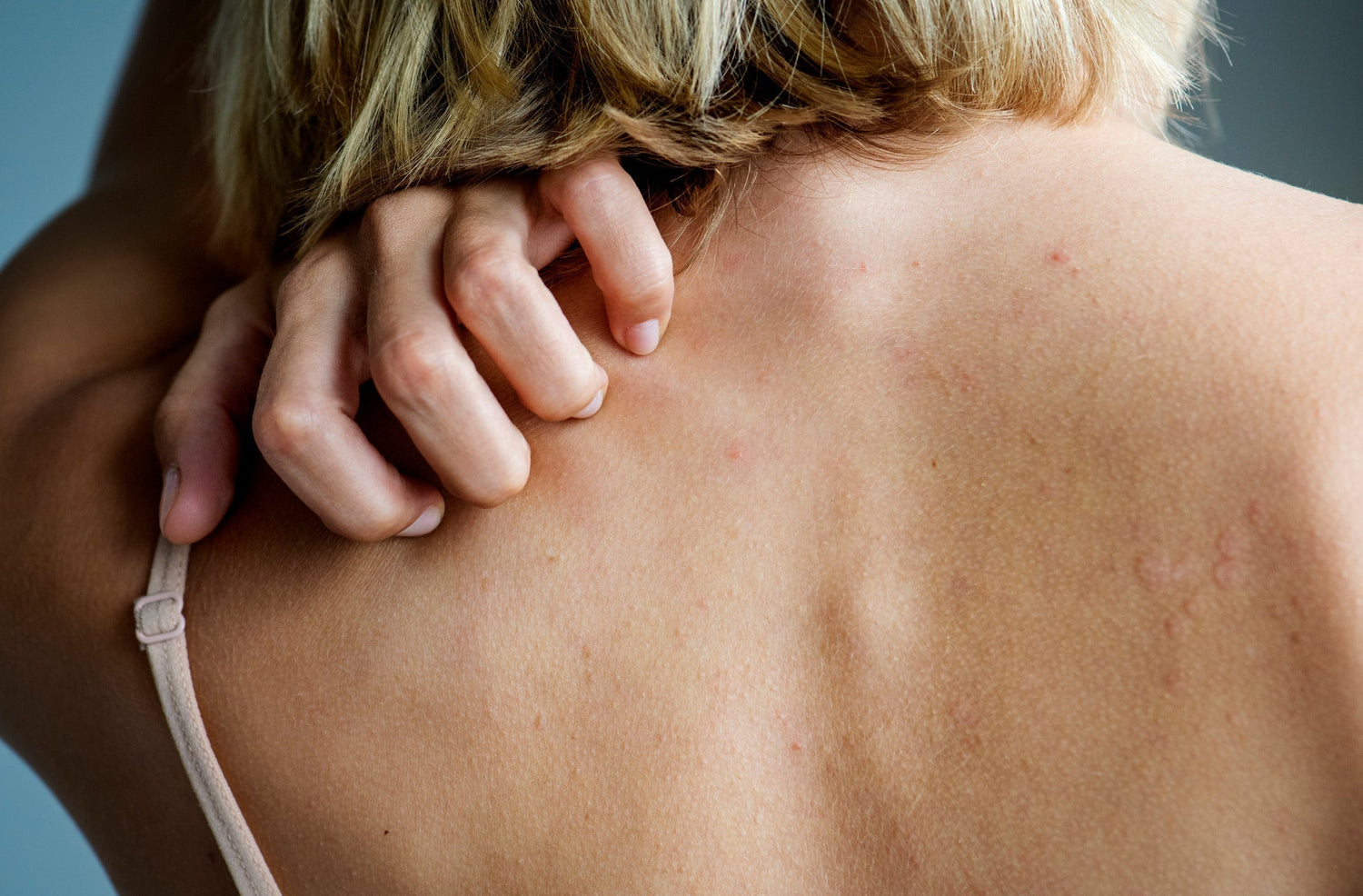 Qu’est-ce qui déclenche une dermatite atopique ?