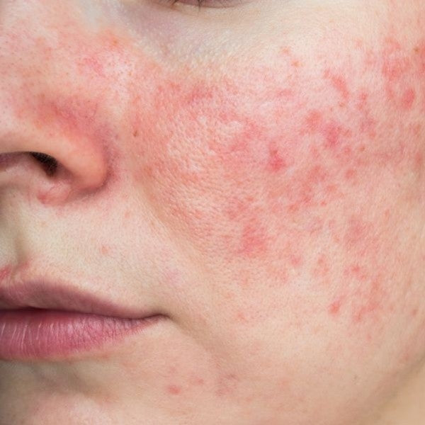 Rosacée : symptômes, traitements efficaces et routine pour apaiser les rougeurs