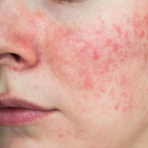 Rosacée : symptômes, traitements efficaces et routine pour apaiser les rougeurs